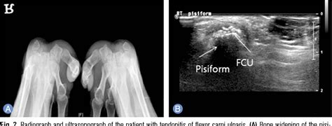 surgical management  pisiform bone deformity