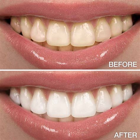 teeth whitening family  childrens dentistry atlanta georgia