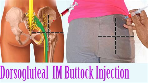 How To Give An Im Intramuscular Injection In The Buttocks Hip
