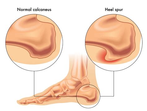 physical therapy  bone spurs heel spurs