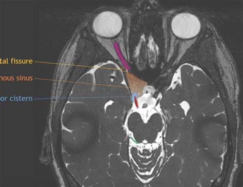 casestackscom cranial nerve anatomy  mri