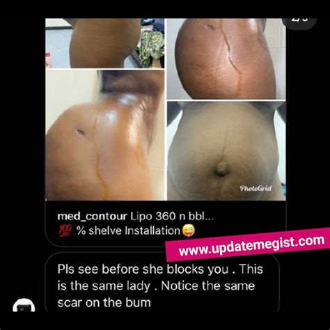 Friend Of Girl Who Accused Surgeon Of Damaging Her Booty Shares Photos