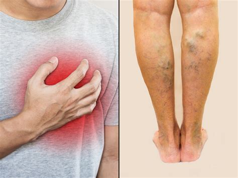 heart disease symptoms swelling    legs    warning