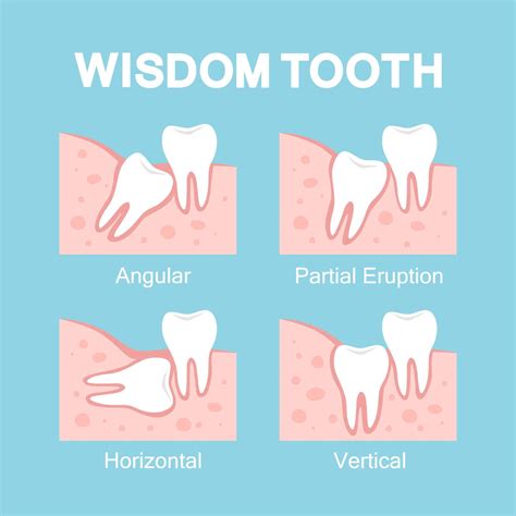 wisdom teeth removal cost breakdown teeth wisdom