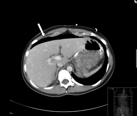 hollow viscus injury journal  emergency medicine