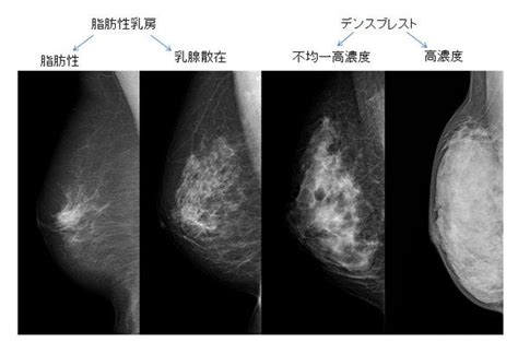 マンモグラフィで乳がんが見つかりにくい「高濃度乳房」って？ 自分の乳腺濃度を知ろう Oggi Jp