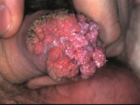 Sexual health chester