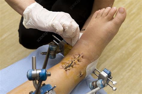surgical wounds infected  mrsa stock image  science photo library
