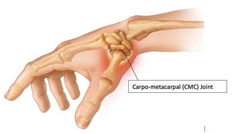 base  thumb arthritis fife virtual hand clinic