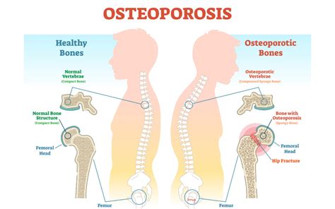 Health Tip Risk Factors For Male Osteoporosis Comprehensive Orthopaedics