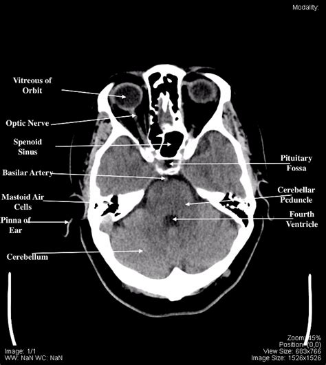 ct scan tips protocols ct brain anatomy