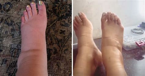 swollen feet  pregnancy    explained