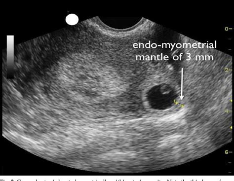 figure   modern management  cornual ectopic pregnancy semantic