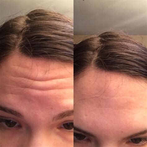 routine    forehead wrinkles rskincareaddiction