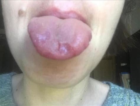 nhs urged  recognise covid tongue  sign   disease  experts