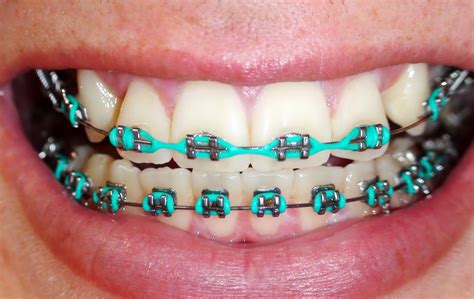 teal braces images braces bands cute braces colors cute braces