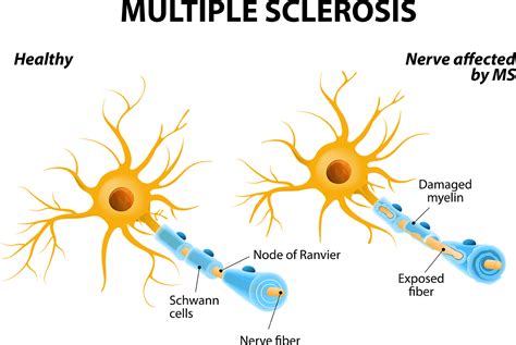 early warning signs  multiple sclerosis regional neurological associates