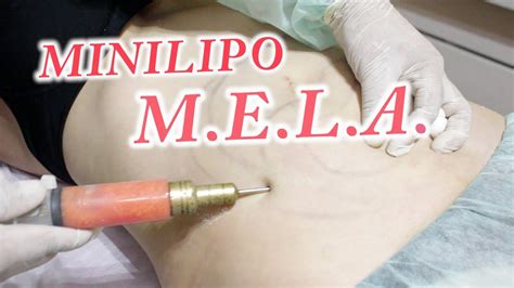 mini lipoescultura mela mini extraccion lipidica ambulatoria tratamiento en adiposidad