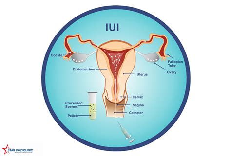 Intrauterine Insemination Iui Treatment In Aundh Pune