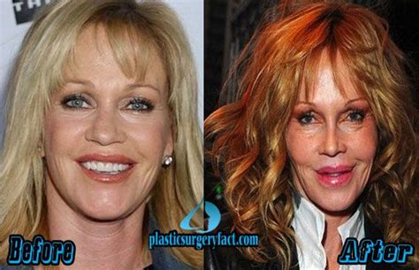 Melanie Griffith Before And After Plastic Surgery Worst