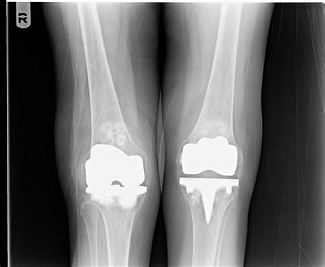 zimmer mg ii total knee prosthesis implant  orthopaediclistcom