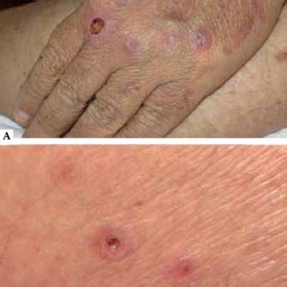 panoramic view showing papules  erythematous nodules  central  scientific