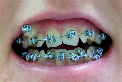 dental care braces  adults