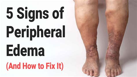 5 signs of peripheral edema and how to fix it