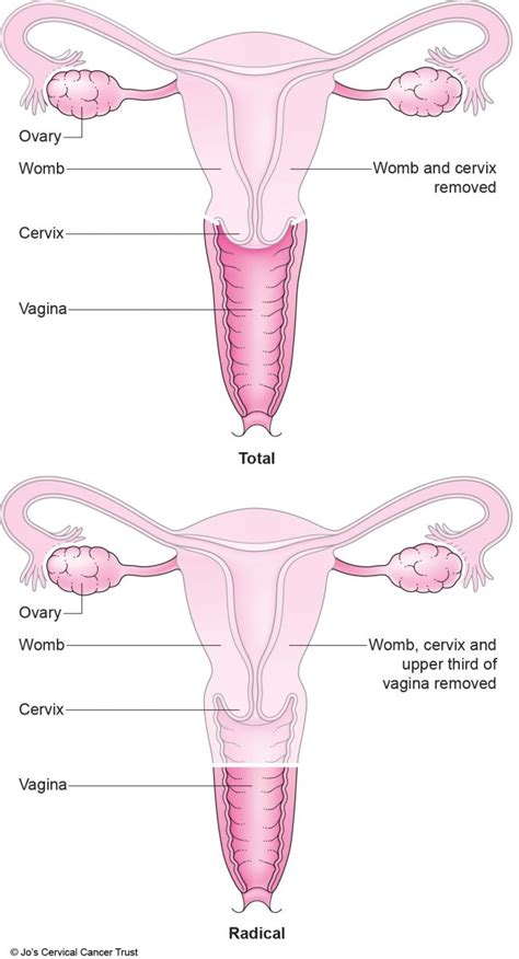 cervical irritation after sex after hysterectomy