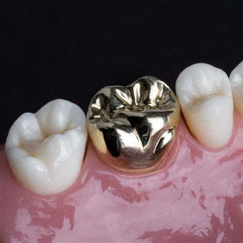 full gold crowns dms dentistry