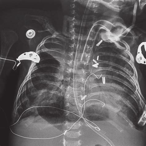 Chest X Ray Showing Right Upper Lobe Collapse With Right Middle Zone