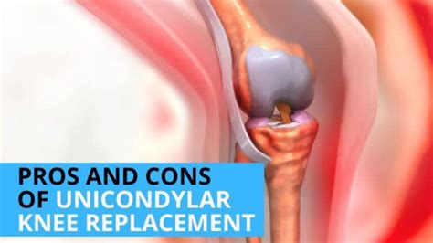 pros  cons  unicondylar knee replacement   worthy