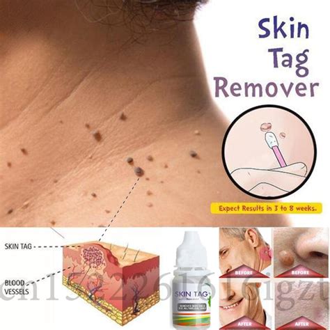 buy chinese medicine treatment skin warts