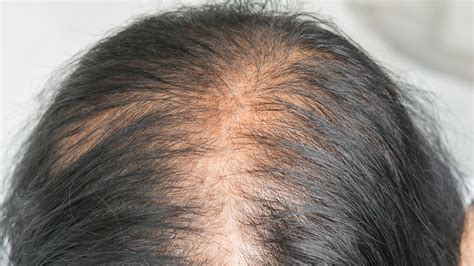 top  image covid hair loss female thptnganamsteduvn