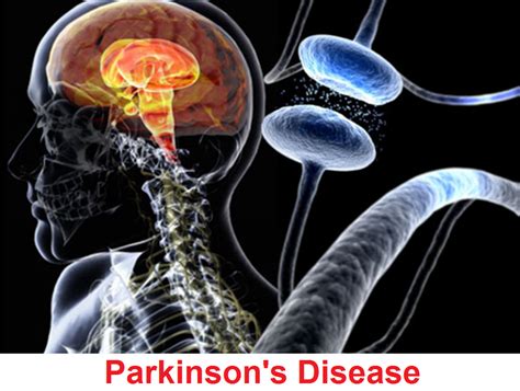 parkinsons disease signs  symptoms diagnosis treatment  prevention