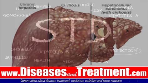 hepatitis b signs and symptoms of sexually transmitted disease std in men youtube