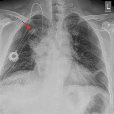 Chest X Ray Pa View Showing The Right Upper Lobe Mass Pa Posterior