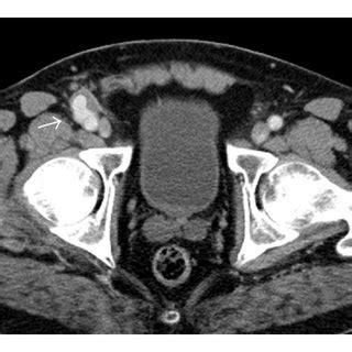 small aneurysma spurium    common femoral artery arrow