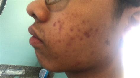 ideas        acne marks   lip racne