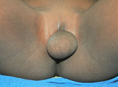 circumcised female clitoris datawav