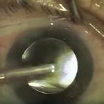 reasons     surgeon  clean   cataract removal
