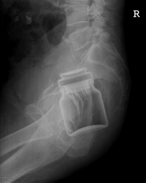 X Rays That Prove People Will Shove Pretty Much Anything