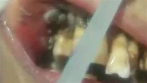 dentist takes    disgusting case   mouth full  wriggling maggots daily record