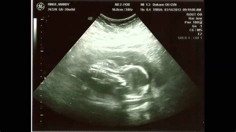 fetal heartbeat at 21 weeks youtube