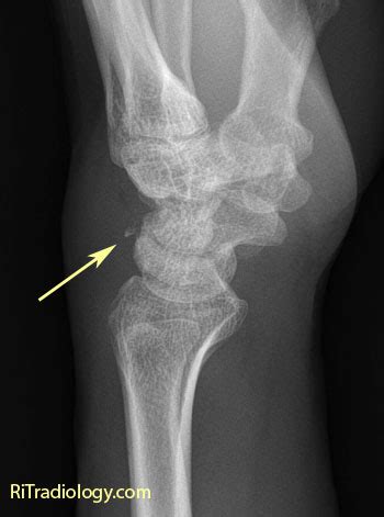 rit radiology triquetral fracture