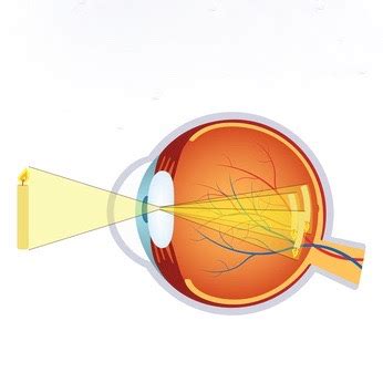astigmatismus ursachen beschwerden therapie gesundpediade