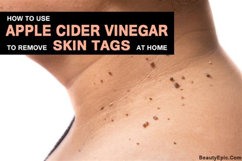 apple cider vinegar for skin tags how to use it