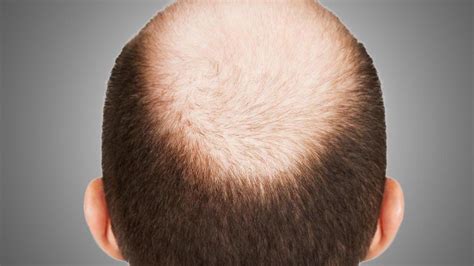 Cure For Male Pattern Baldness Involves Stem Cells From