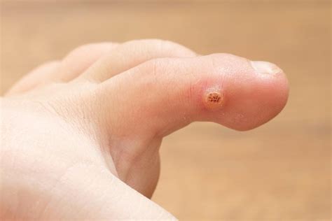where are plantar warts located instride queen city foot and ankle