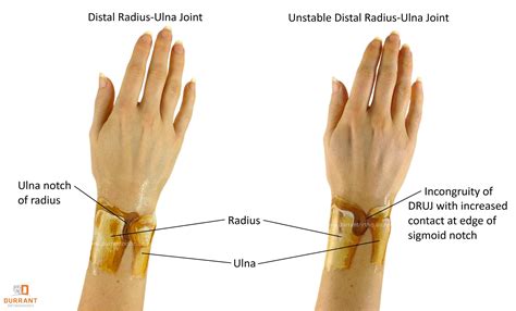pin  hand  wrist injuries
